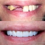 Efekt przed i po implantach All-on-4 w Ensenada Dental – pełna odbudowa uśmiechu