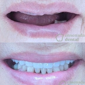 Efekt przed i po implantach All-on-4 w Ensenada Dental – pełny uśmiech