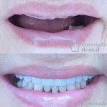 Efekt przed i po implantach All-on-4 w Ensenada Dental – pełny uśmiech