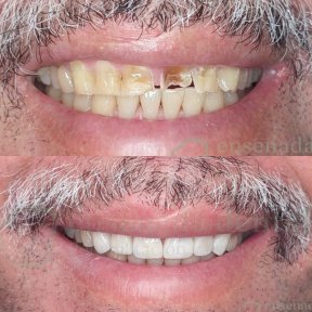 Before and after veneers result at Ensenada clinic – smile restoration and whiter teeth