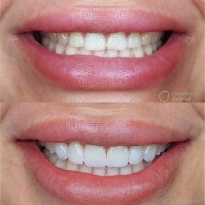Before and after veneers result at Ensenada Dental – smile transformation with whiter teeth