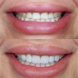 Before and after veneers result at Ensenada Dental – smile transformation with whiter teeth