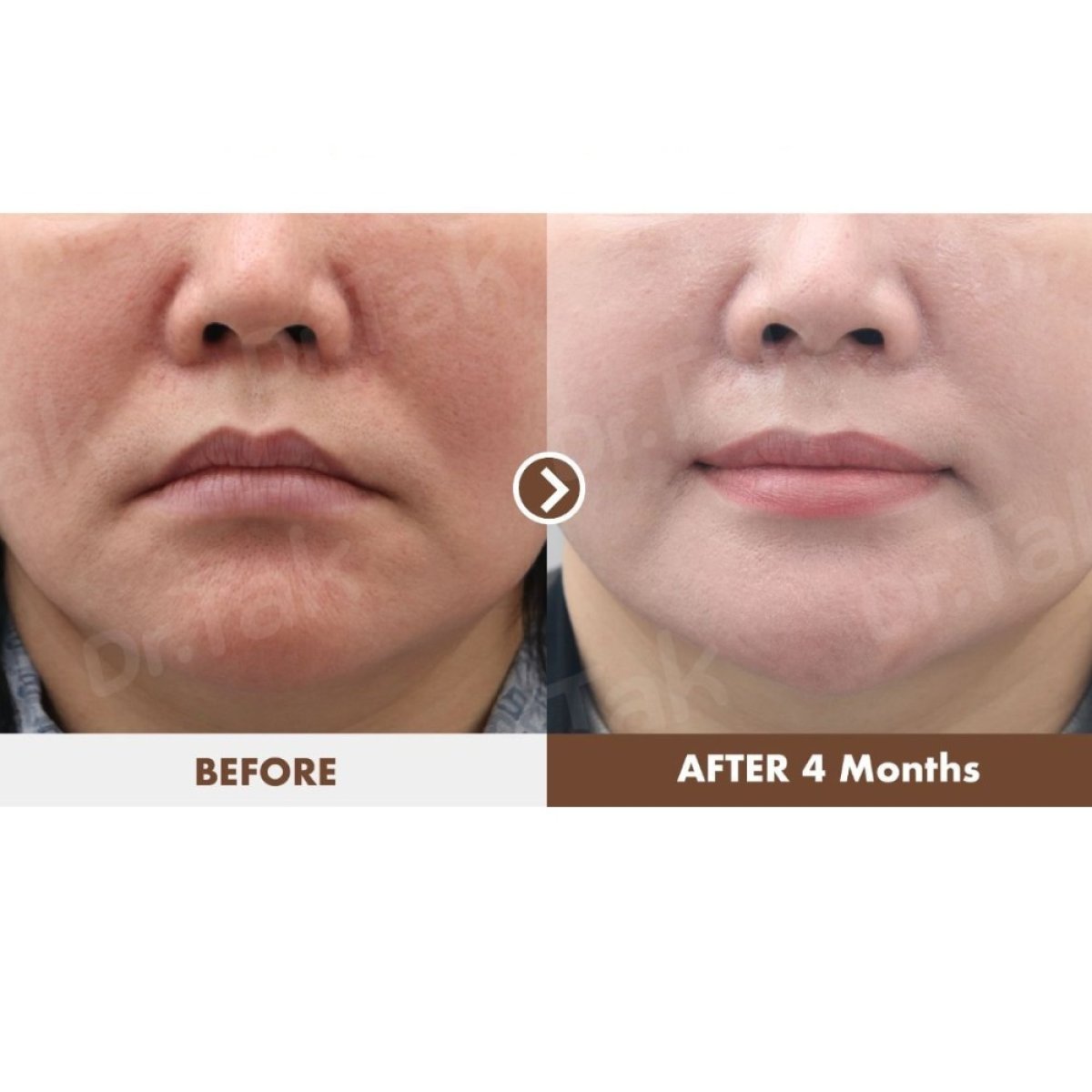 Resultados de lifting de labios antes y después en Dr. Tak Plastic Surgery, contorno mejorado tras 4 meses