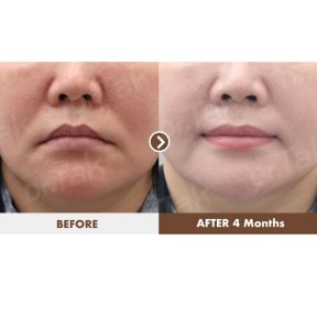 before-after photo lip-lift