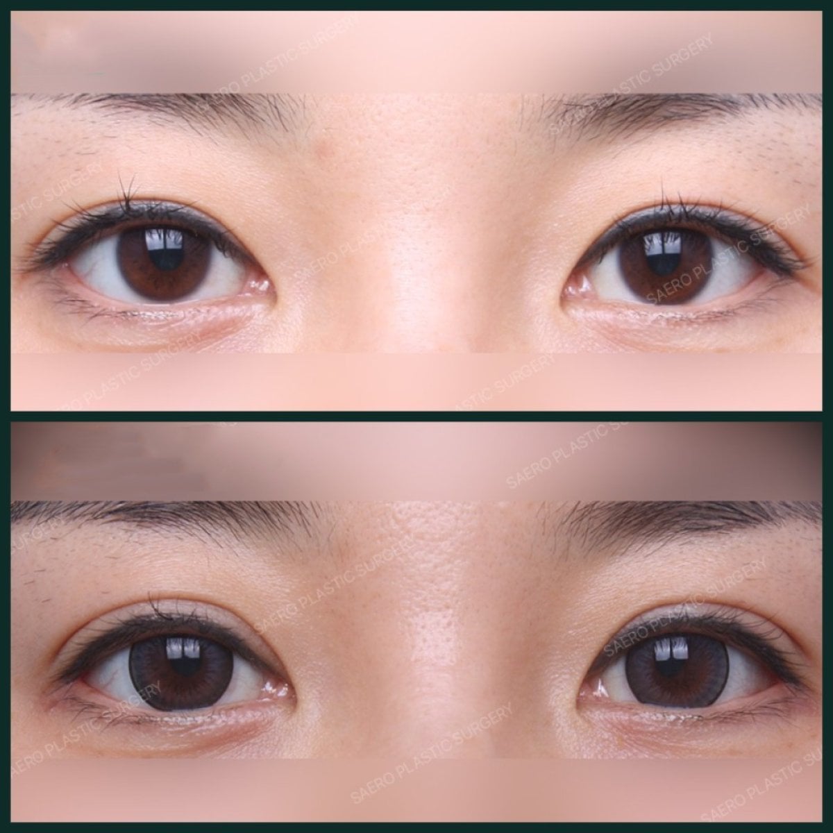 Resultados de blefaroplastia antes y después en SAERO Plastic Surgery, corrección de párpados