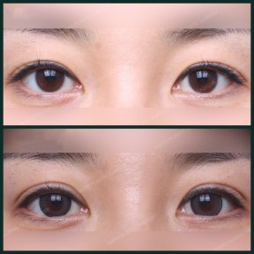 before-after photo blepharoplasty-eyelid