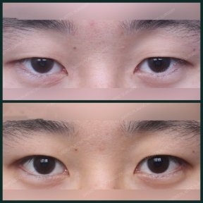 before-after photo blepharoplasty-eyelid