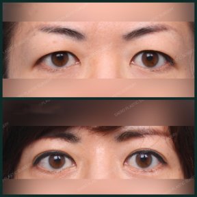 before-after photo blepharoplasty-eyelid