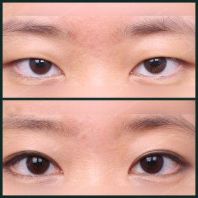 before-after photo blepharoplasty-eyelid