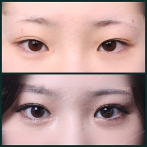 before-after photo blepharoplasty-eyelid