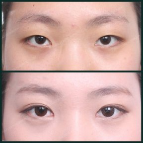 before-after photo blepharoplasty-eyelid