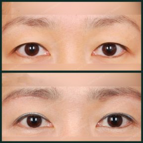 before-after photo blepharoplasty-eyelid
