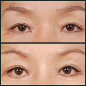 before-after photo blepharoplasty-eyelid