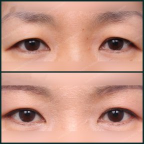before-after photo blepharoplasty-eyelid