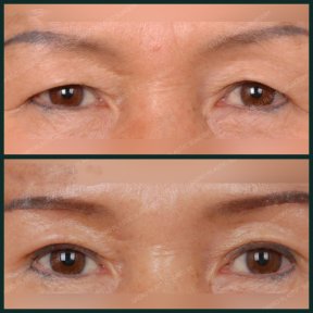 before-after photo blepharoplasty-eyelid