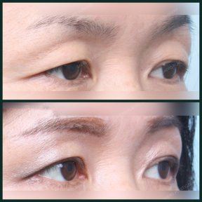 before-after photo blepharoplasty-eyelid