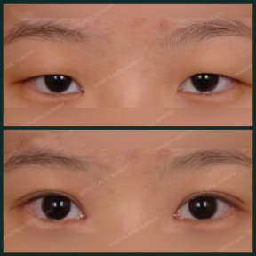 before-after photo blepharoplasty-eyelid