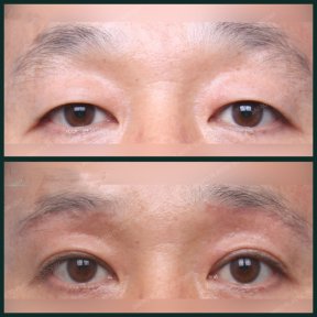 before-after photo blepharoplasty-eyelid