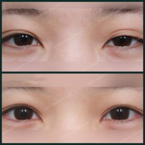 before-after photo blepharoplasty-eyelid