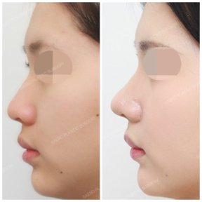 before-after photo rhinoplasty-nose-job