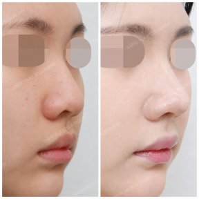 before-after photo rhinoplasty-nose-job