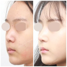 before-after photo rhinoplasty-nose-job