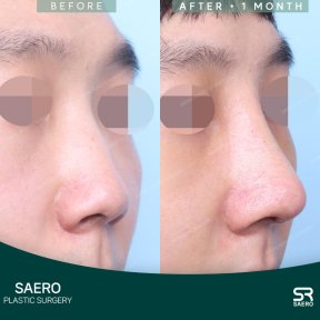 before-after photo rhinoplasty-nose-job