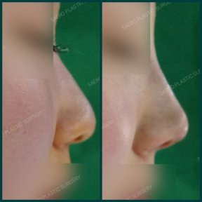before-after photo rhinoplasty-nose-job