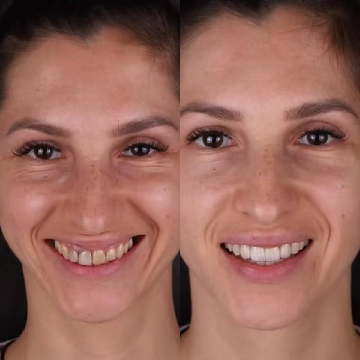 نتائج تبييض الأسنان قبل وبعد في عيادة Go To Smile – ابتسامة أكثر بياضًا بوضوح