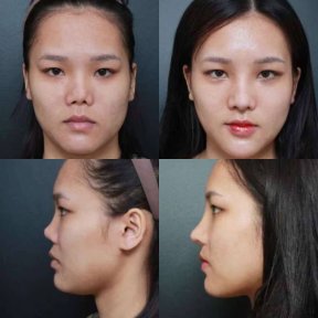 before-after photo tip-rhinoplasty