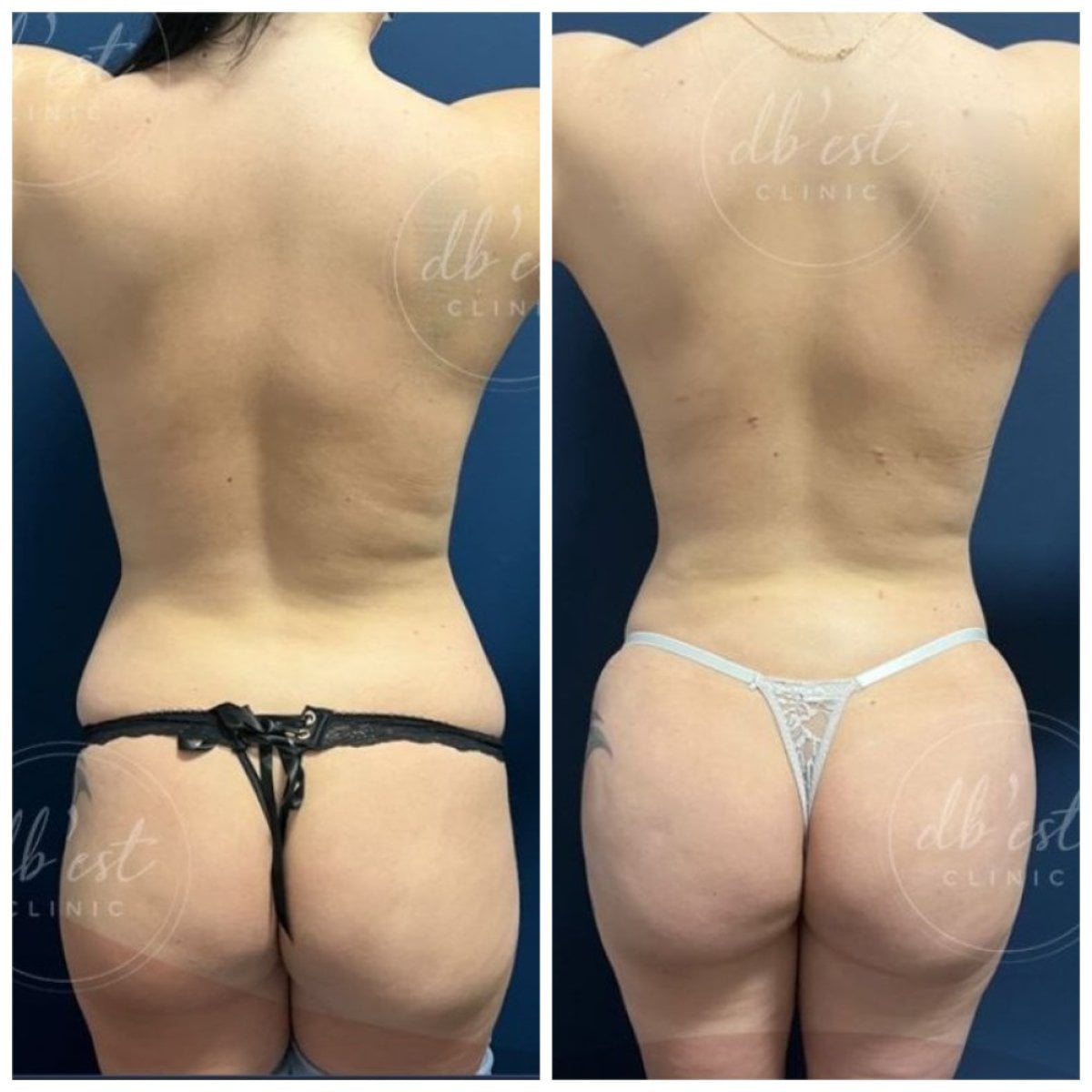 نتائج قبل وبعد عملية Brazilian Butt Lift في Db'est Clinic – تحسين شكل الأرداف