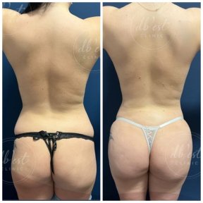 before-after photo brazilian-butt-lift