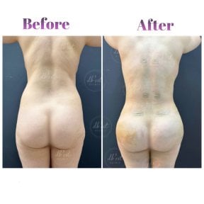 before-after photo brazilian-butt-lift