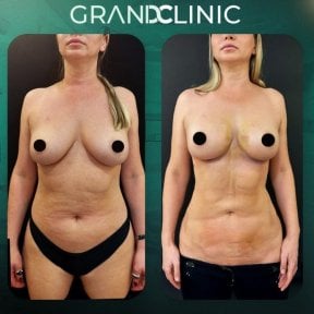 before-after photo mammoplasty