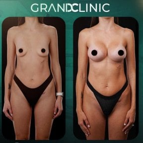 before-after photo mammoplasty