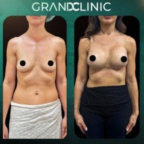 before-after photo mammoplasty