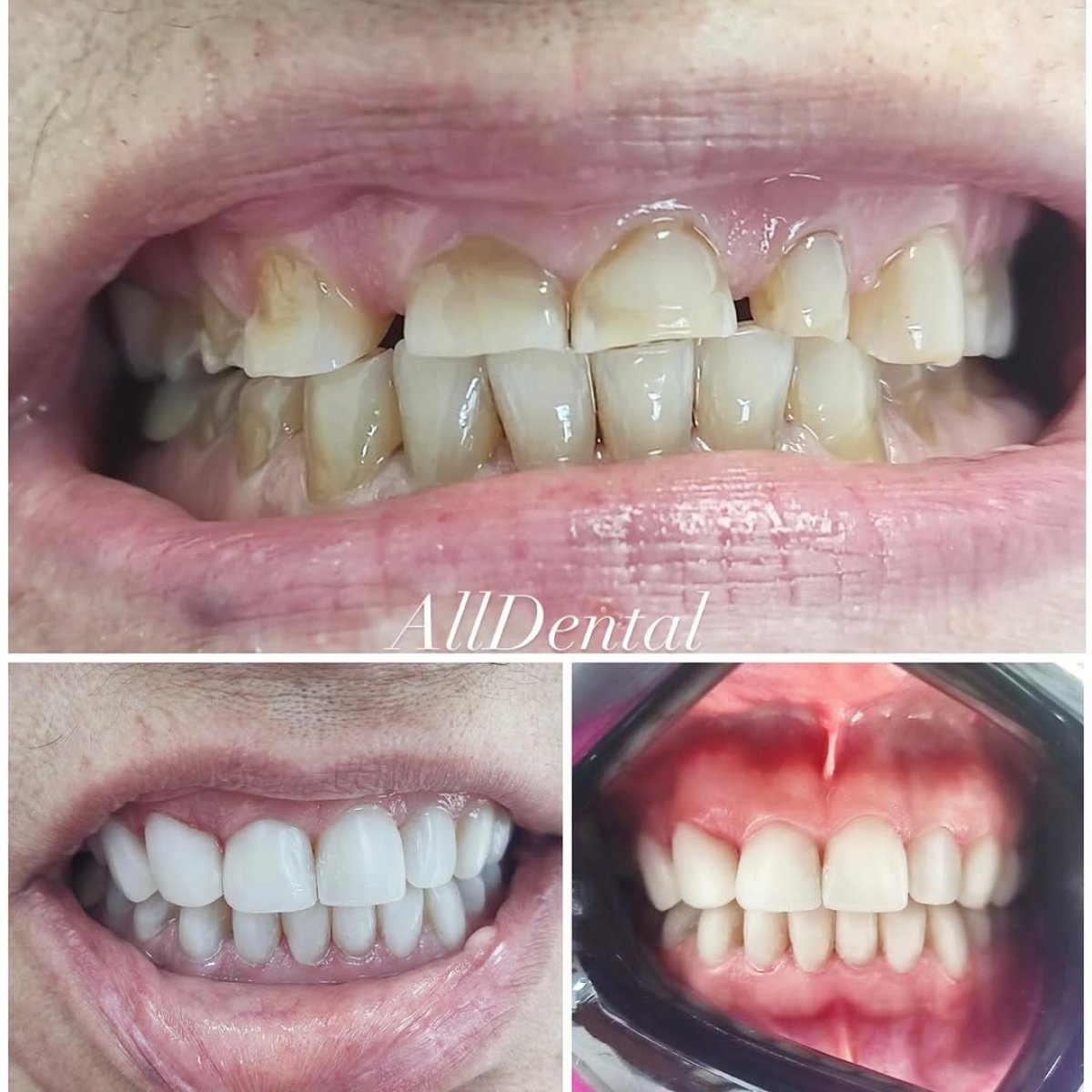 نتائج قبل وبعد تركيب تيجان الأسنان في AllDental Clinic، تحسين مظهر الابتسامة