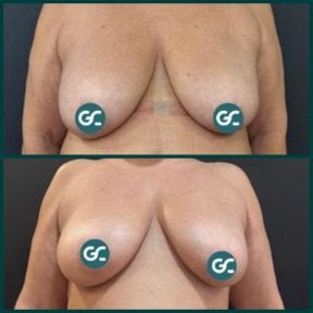 before-after photo mammoplasty