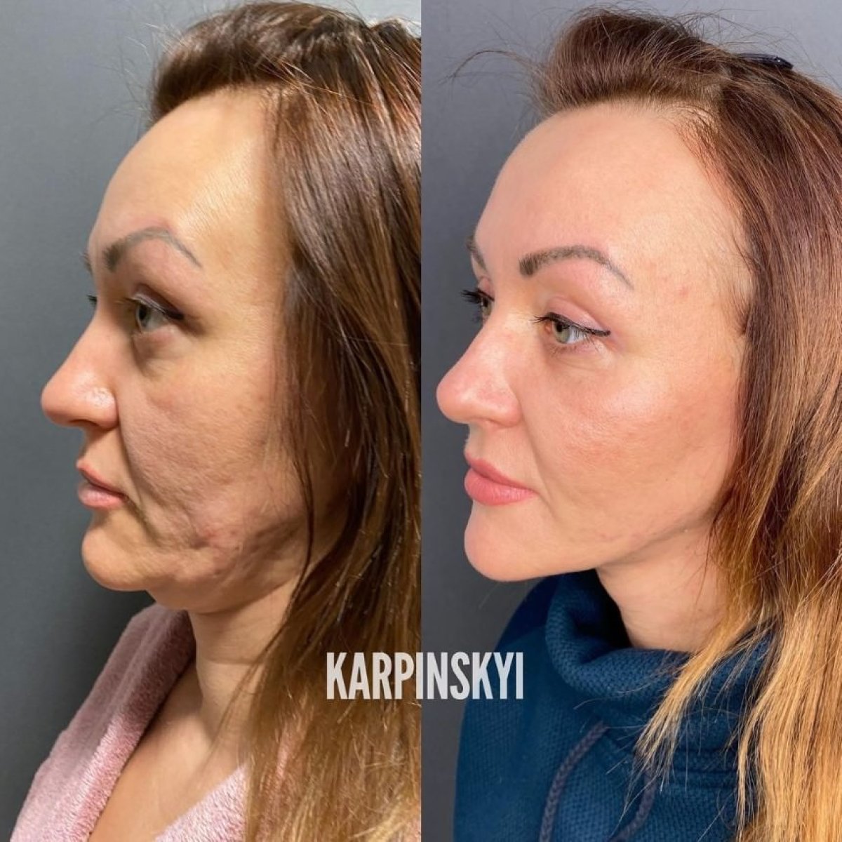 Resultados de lifting facial antes y después en Lita Plus, rejuvenecimiento visible