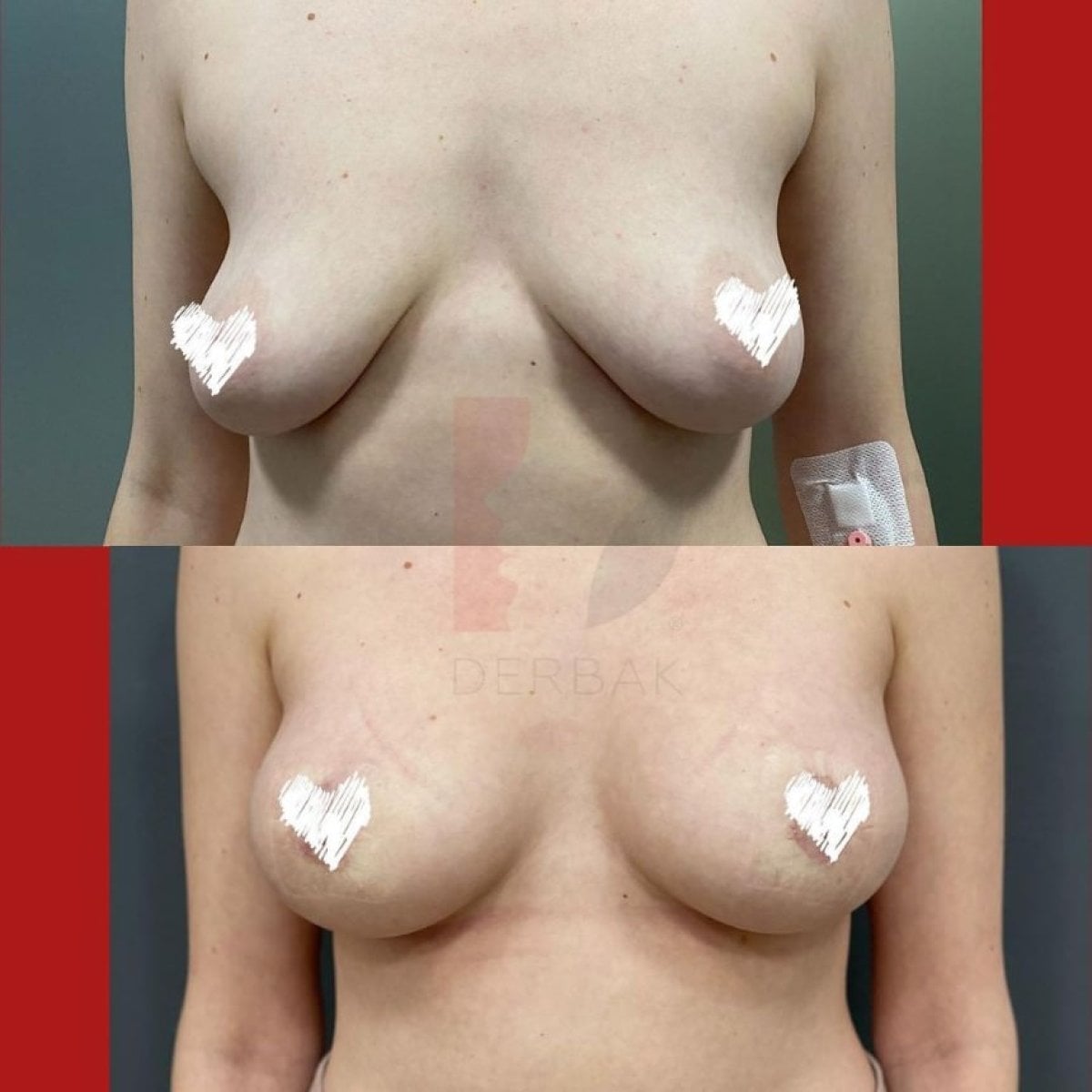 Resultados de lifting de senos antes y después en Lita Plus, mejora de forma y contorno