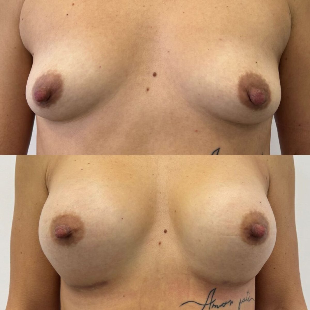 قبل وبعد تكبير الثدي في Lita Plus، نتيجة زيادة حجم وشكل الثدي