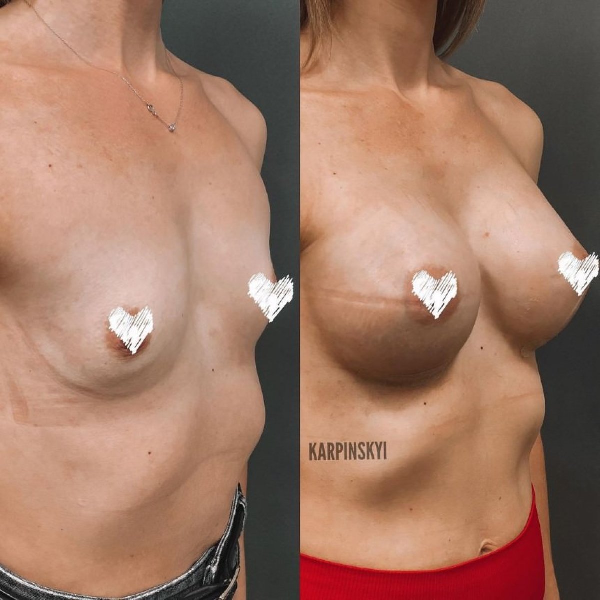 قبل وبعد تكبير الثدي في Lita Plus، نتيجة زيادة حجم وتحديد الثدي