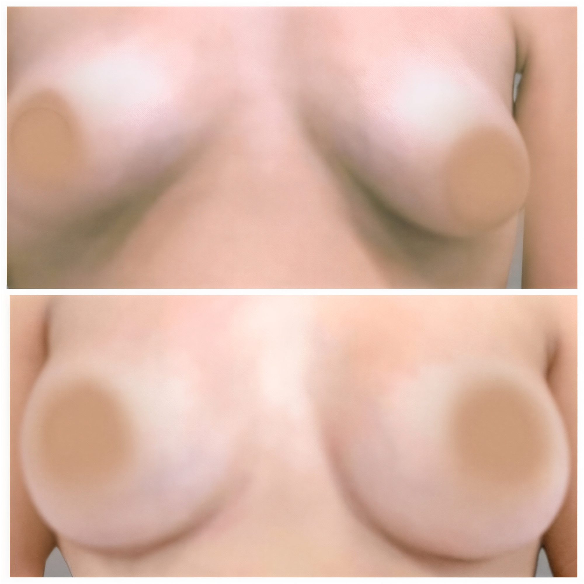 Resultados de mamoplastia antes y después en MyMoment – mejora de forma y simetría mamaria