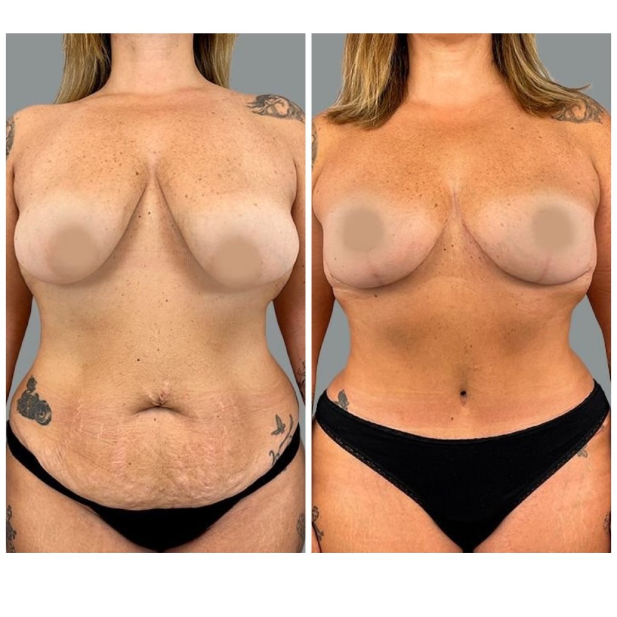 Resultados de abdominoplastia antes y después en MyMoment: abdomen plano y cintura definida