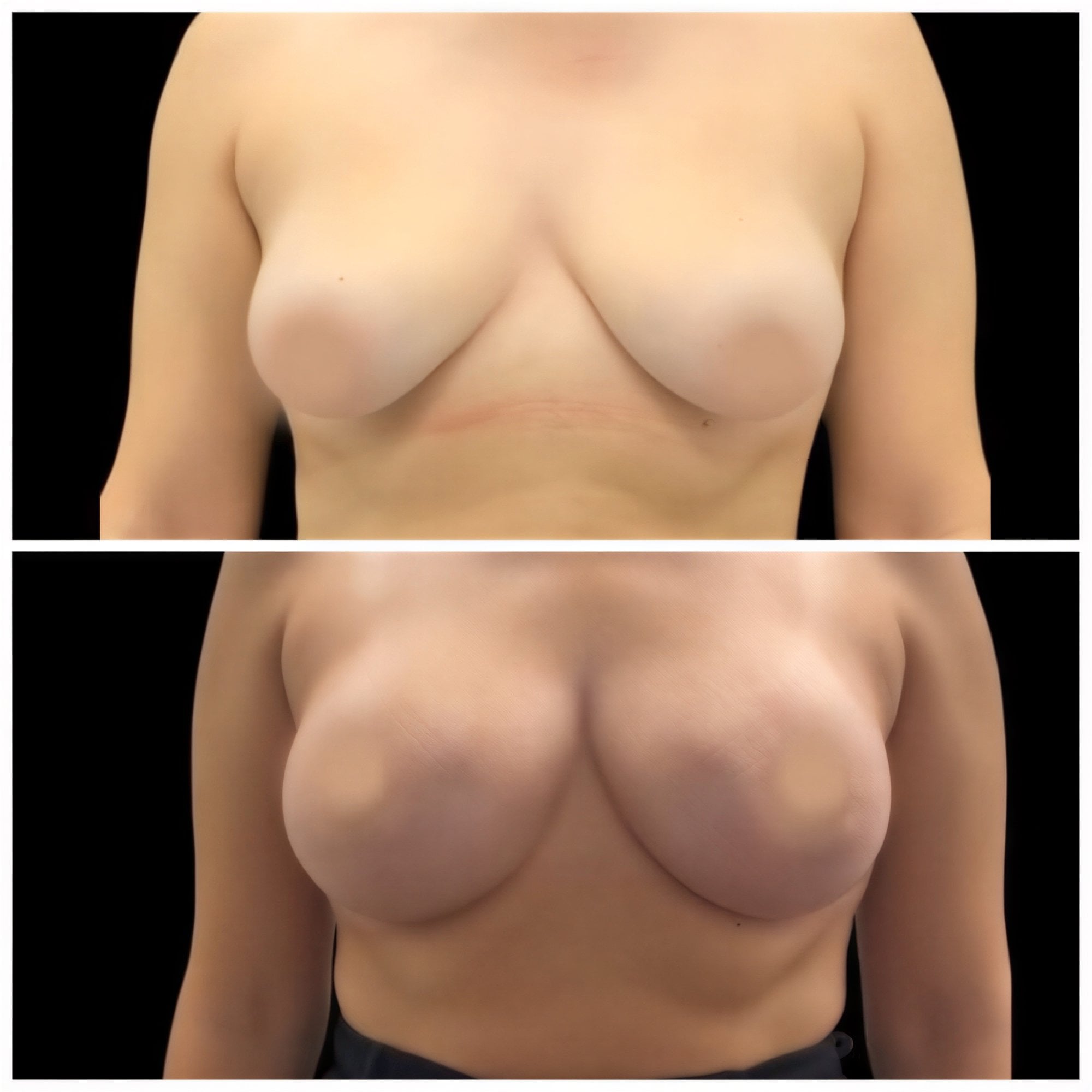 Resultados antes y después de lifting de senos en MyMoment – mejor forma y contorno