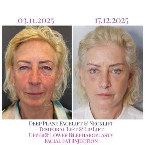 before-after photo lip-lift