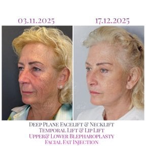 before-after photo lip-lift