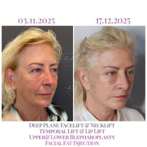 before-after photo lip-lift