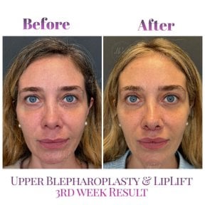 before-after photo lip-lift