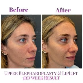 before-after photo lip-lift